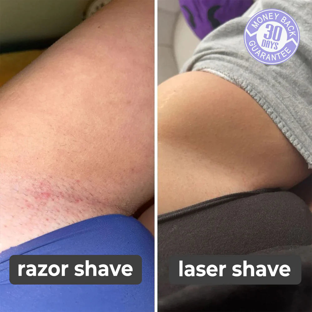 Laser Hair Removal Device